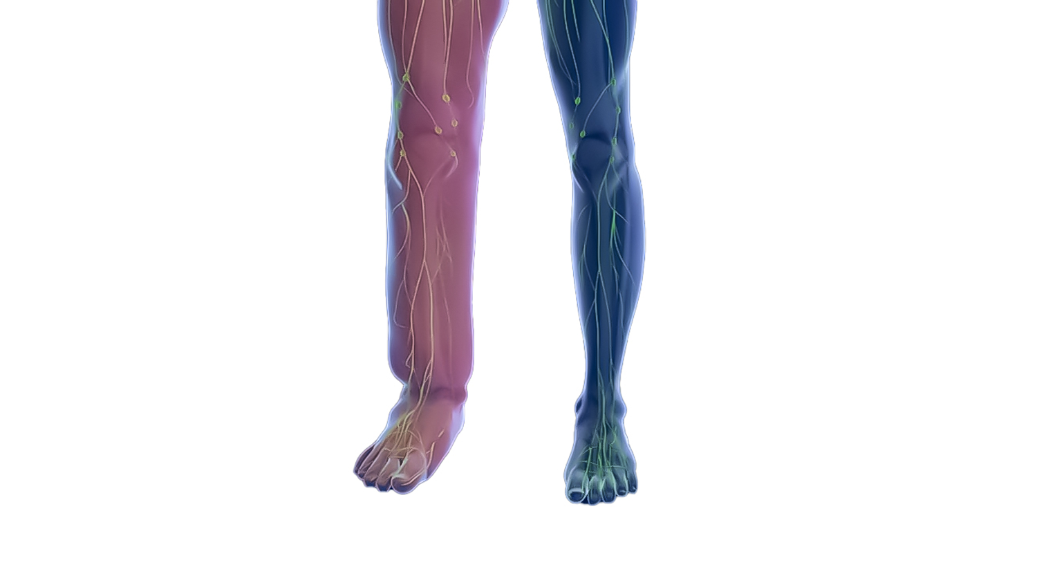 Lymphedema Treatment in Secunderabad