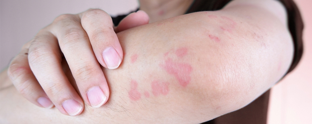 Vasculitis Treatment in Hyderabad